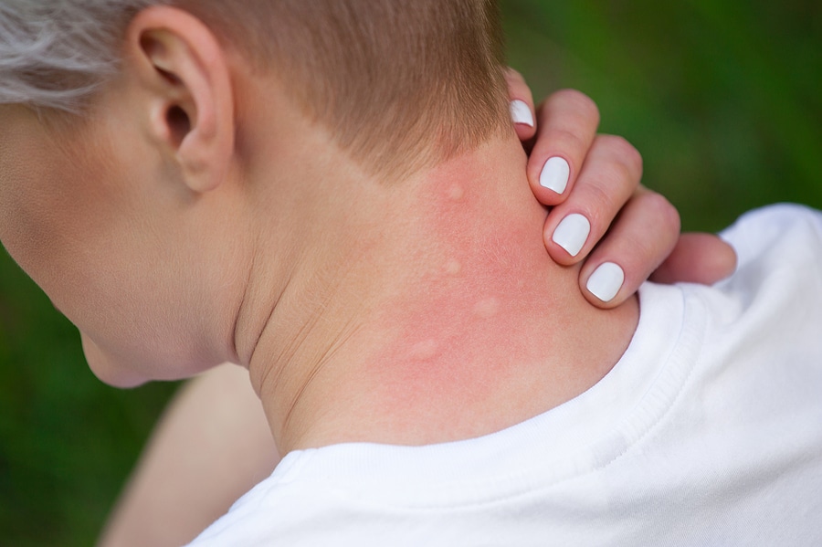 Photo of short-haired girl sitting with her back turned, scratching her mosquito-bitten neck. Close-up up of visible insect bites on irritated skin.